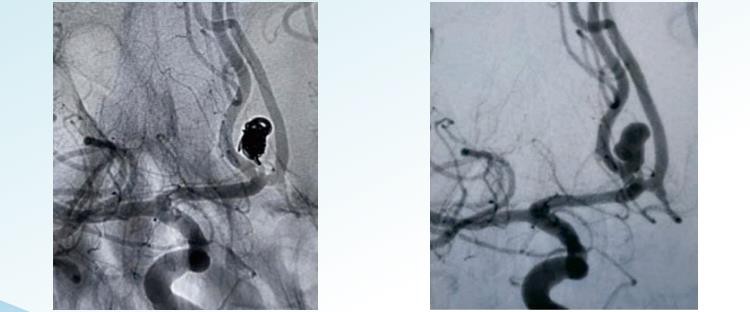 Aneurysm Endovascular Coiling