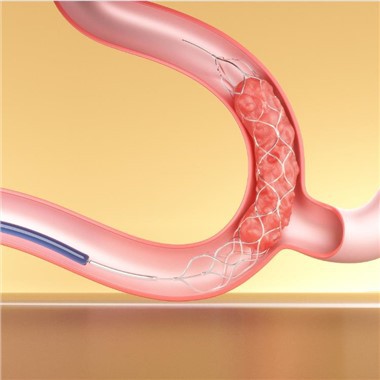 Thiết bị cắt huyết khối Stent Retriever